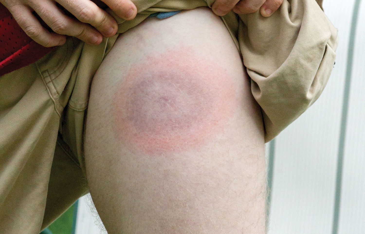 Know the Signs and Symptoms of Lyme Disease • Sentara RMH Magazine